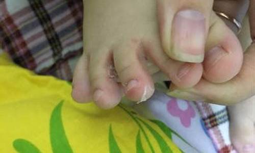2岁幼儿脚气-两岁宝宝 脚气