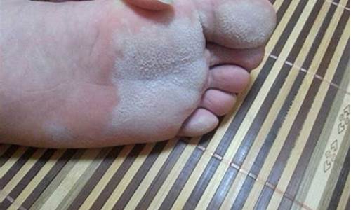 脚气出现的症状是什么-脚气的预兆是什么