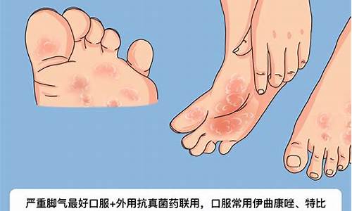 感染脚气怎么办-脚气严重感染皮肤溃烂