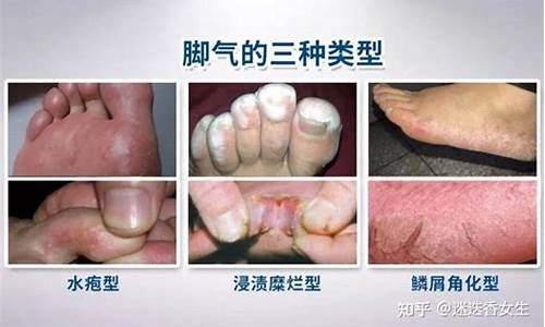 脚气感染怎样治疗-脚气感染初期前期症状
