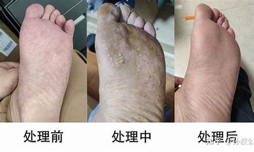干性脚气病和湿性脚气病-干性脚气病与湿性脚气病