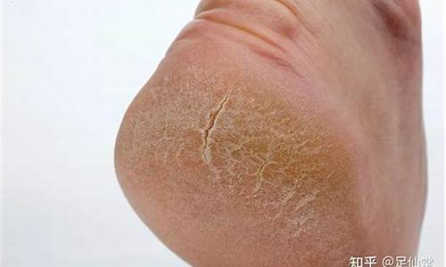 干燥脱屑脚气如何治愈-干燥脱屑脚气怎么治疗