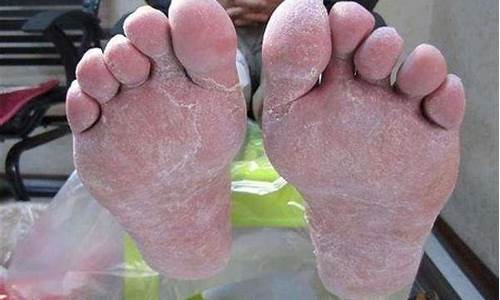 脚气引起的丹毒症状-脚气引起的丹毒症状有哪些