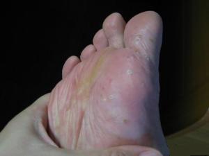 水疱型脚气的治疗方法