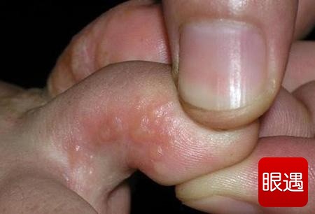 水泡型脚气的症状(图)